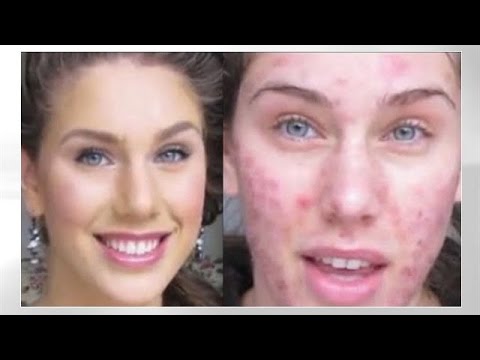 Acne Foundation Routine! Pimples, Scars, Cystic Acne, Blackheads & Oil! | Cassandra Bankson
