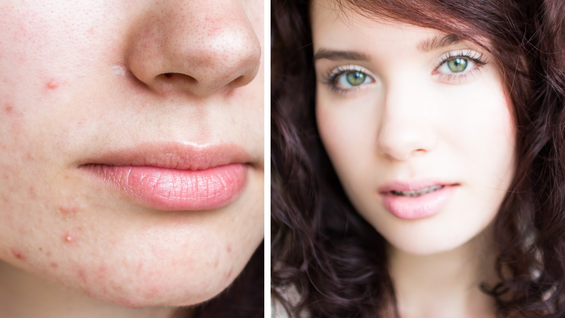 How To Cover Acne & Scars | My Full Coverage Mineral Foundation Routine – NON-COMEDOGENIC, NATURAL